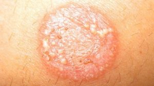 Skin Disorders Eczema Scabies Tinea Corporis Regency - vrogue.co