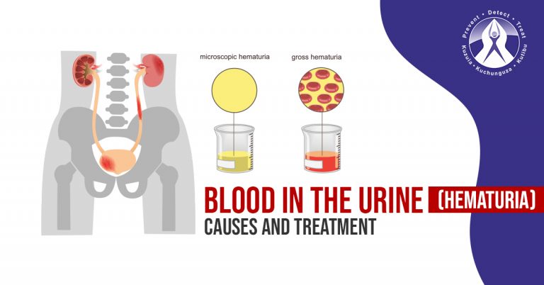 urine-part-13-urine-protein-proteinuria-spot-test-for-urine