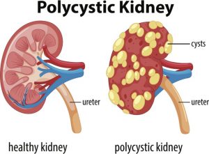 Blood in the Urine (Hematuria): Causes and Treatment | Regency Hospital