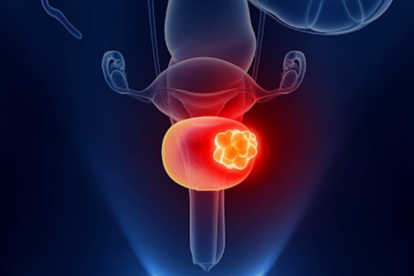 Bladder Cancer: Types, Causes & The Right Treatment | Regency Hospital