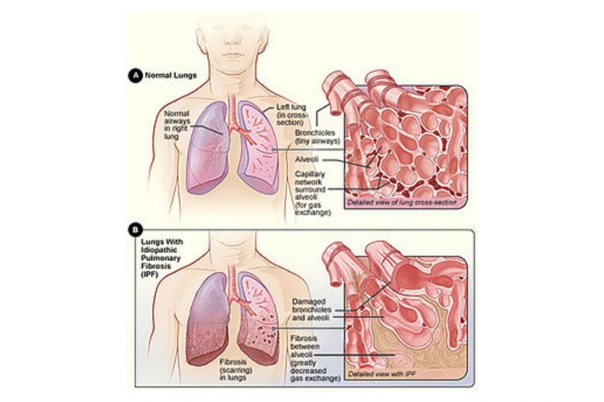 Pulmonary Fibrosis: Symptoms, Diagnosis, and Treatment