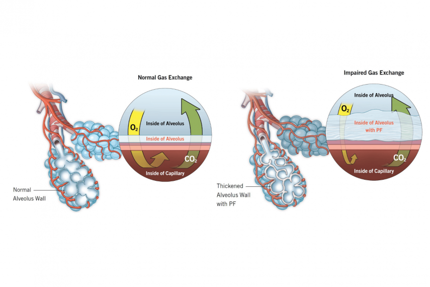 pulmonary-fibrosis-symptoms-diagnosis-and-treatment