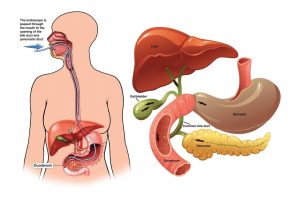 Endoscopic Retrograde CholangioPancreatography (ERCP) procedure