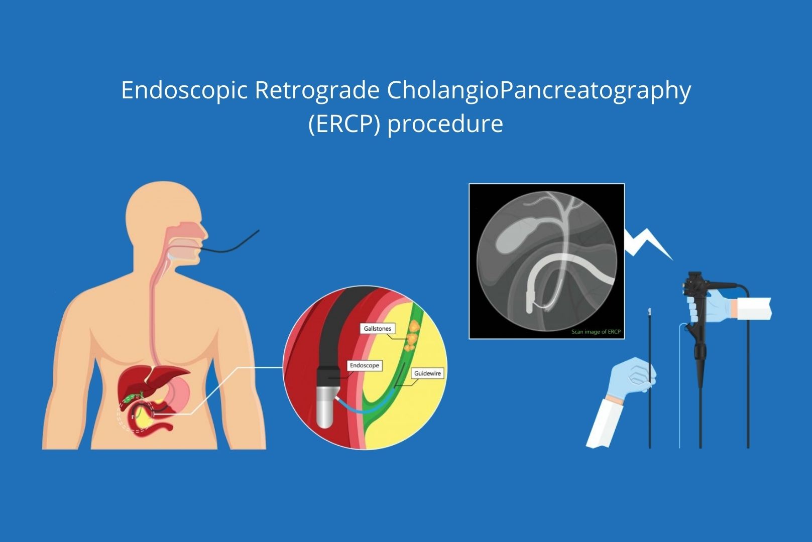 Endoscopic Retrograde CholangioPancreatography (ERCP) procedure