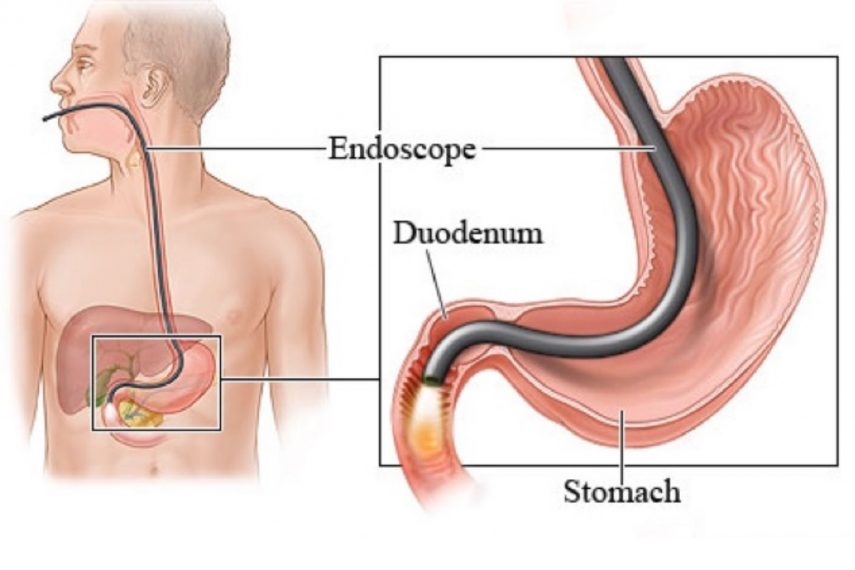 understanding-oesophago-gastro-duodenoscopy-ogd-and-colonoscopy