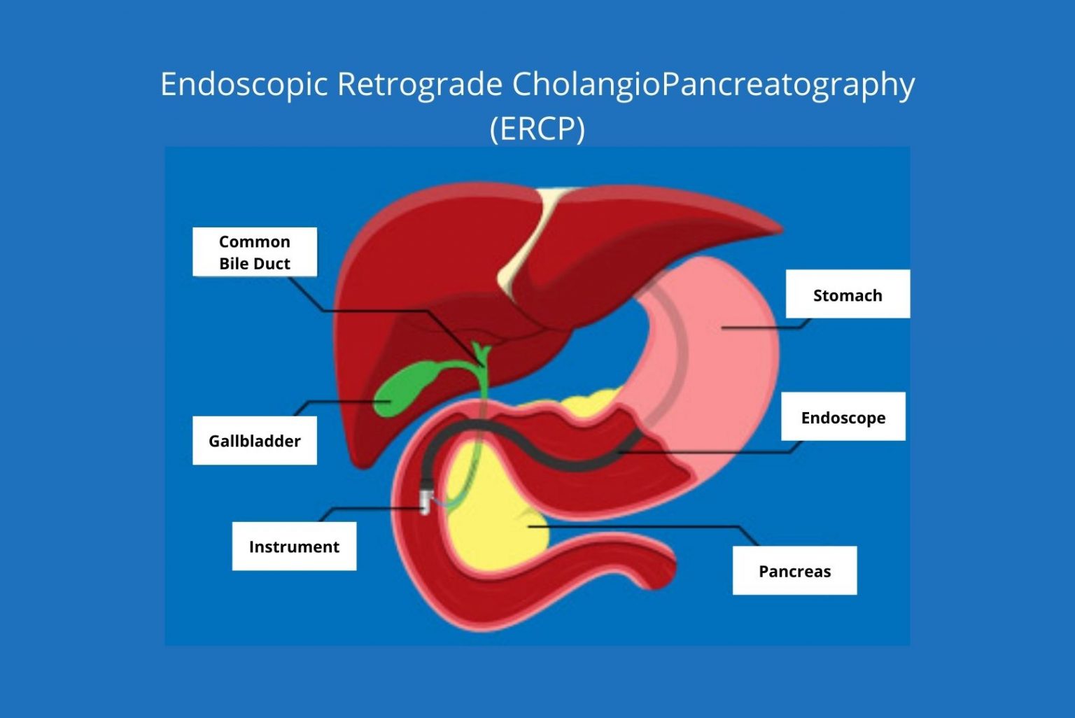 endoscopic-retrograde-cholangiopancreatography-ercp-procedure