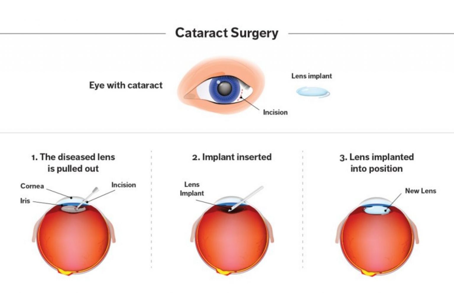 EVERYTHING YOU NEED TO KNOW ABOUT CATARACT! OPHTHALMOLOGY