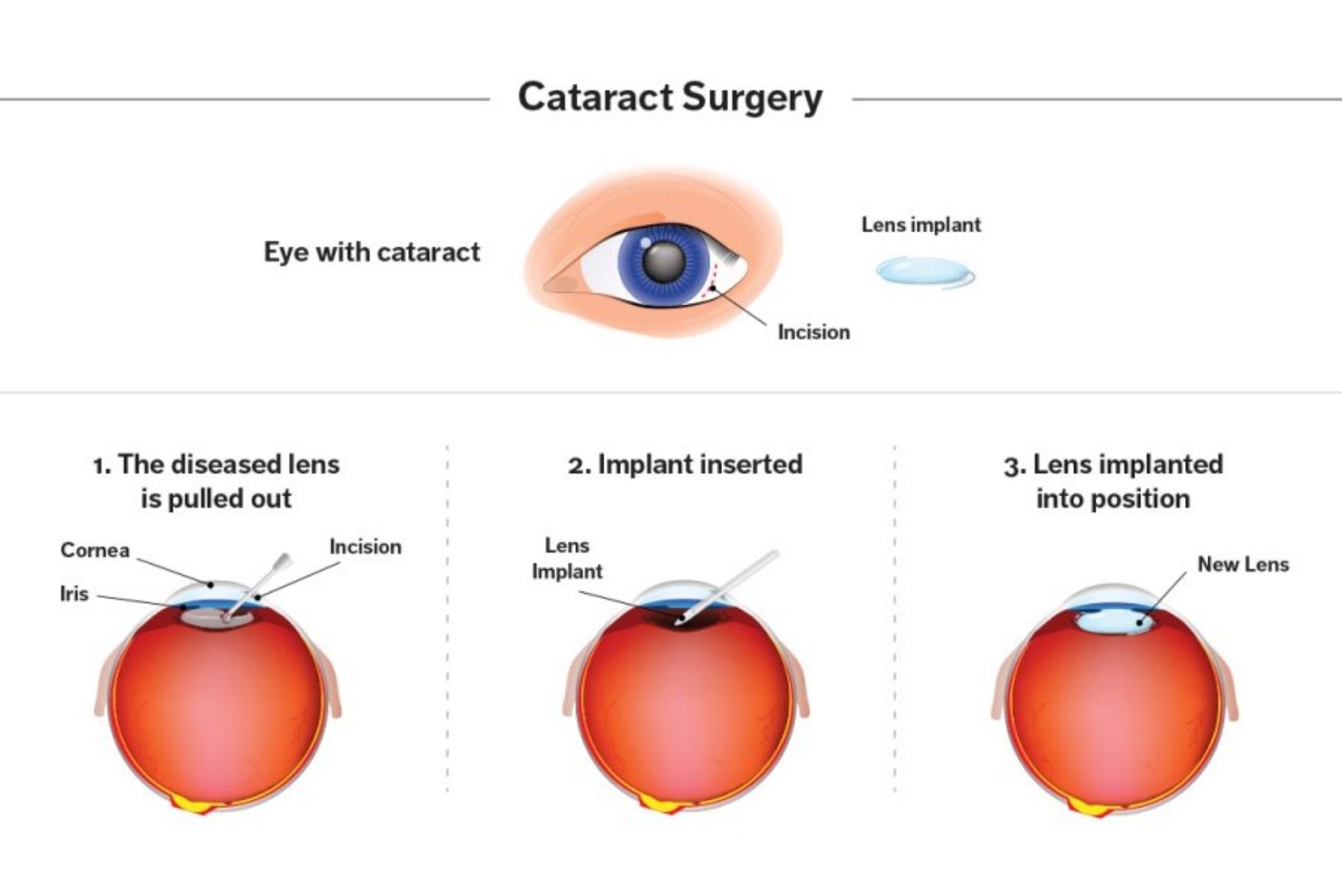 Everything You Need To Know About Cataract Ophthalmology 