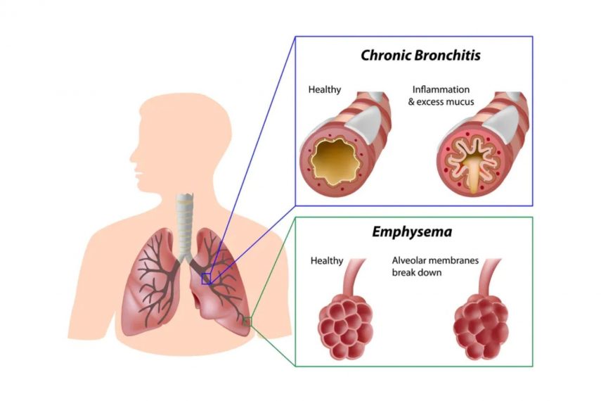 AN INFORMATION GUIDE TO- ‘CHRONIC OBSTRUCTIVE PULMONARY DISEASE ...