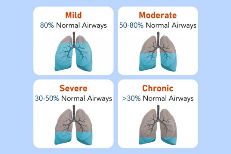 an-information-guide-to-chronic-obstructive-pulmonary-disease