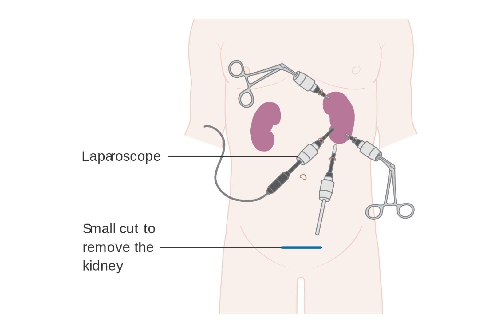 Нефрэктомия лапароскопия